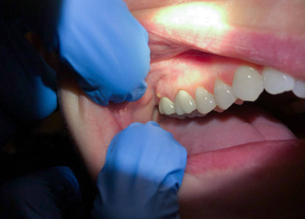 Best Urgent Care for Lost Fillings or Crowns in New Miami, OH